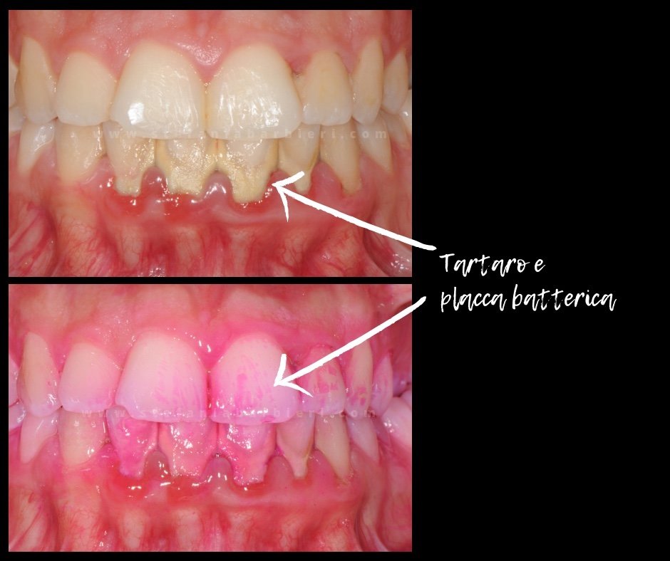 Tartaro e placca batterica 